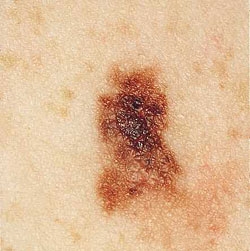 Melanomul malign